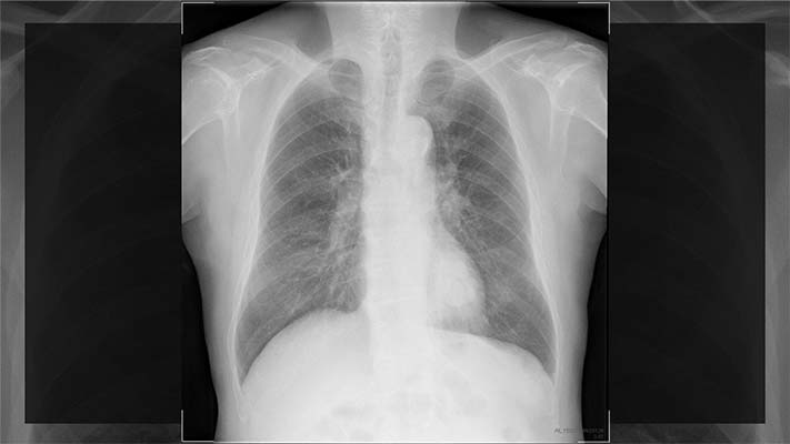 ☆日本の職人技☆ 放射線科 胸部X線写真 異常の見つけ方 判読手順 健康 